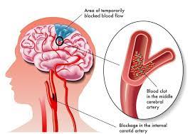 A stroke, also referred to as a cerebral vascular accident (cva) or a brain attack, is an interruption fewer strokes are categorized as hemorrhagic, which occur when weakened blood vessels inside the. These 3 Imaging Tests Can Help Determine Your Risk Of Stroke Rai Health Awareness Blog