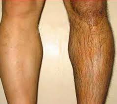 Dis Macunu Kullanarak 10 Dakikada Istenmeyen Tuylerden Kurtulun Unwanted Hair Skin Care Pimples Natural Skin Care