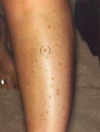 Image result for liver spots on legs