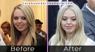 Tiffany Trump S Plastic Surgery President S Daughter Taken The Plunge Plastic Surgery Celebrity Plastic Surgery Plastic Surgery Photos