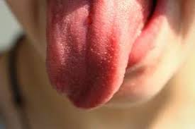 Was hat der arzt gegen die tonsillaris verordnet? á… Pickel Auf Der Zunge Was Hilft Gegen Weisse Rote Gegenpickel