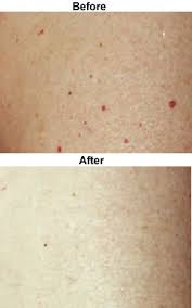 Broken capillaries on chest treatment. Capillary Blemish Treatment Glamaderm Skincare