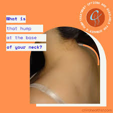 What happens is that the muscle tissue migrates and accumulates at the base of the neck to compensate for the wrong posture. What Is That Hump At The Base Of Your Neck Dowager S Hump San Francisco Chiropractor Chiro Health Inc Voted 1 In San Francisco
