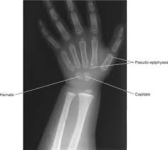 Image result for Hamate Bone