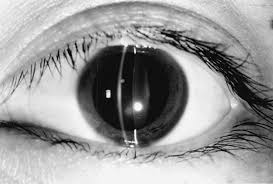 Image result for Mydriasis