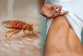 Image result for bedbugs bites