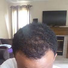 Learn about male hair loss causes and solutions. 25 Black Male Embarrassed My Hair Is Thinning And Hairline Receding What Are My Options Photo