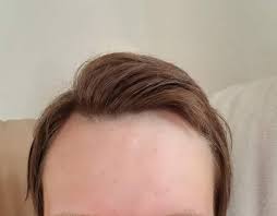 Ein niedriger östrogenspiegel bewirkt bei frauen in der menopause haarausfalll. Wie Soll Ich Meine Haare Schneiden Lassen Habe Auch Haarausfall Bin Ein Madchen Haare Ab