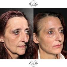 💉 Peri-Oral Rejuvenation + Lip Filler