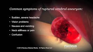 Aneurysmal bleeding often collects within an most will not have symptoms or problems. Cerebral Aneurysm Youtube