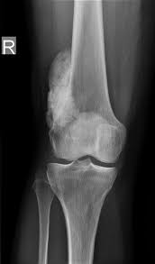 Image result for Osteosarcoma