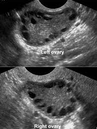 Ovaries Hormonal Cycles And Common Cysts Diagnostic Medical Sonography Medical Ultrasound Polycystic Ovarian Syndrome