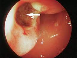 Erbrechen Gastritis Oder Mesenterialinfarkt Klinik Via Medici