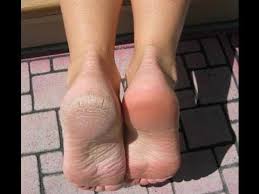 We did not find results for: How I Cure My Dry Feet Youtube