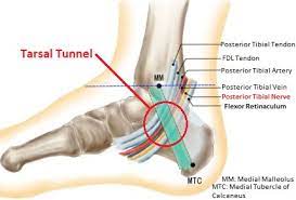 Tarsal Tunnel Syndrome Causes Symptoms Treatment
