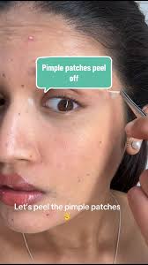 Removing Pimple Patches: Easy Acne Treatment at Home