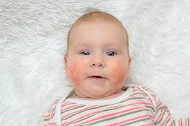 The only concerns parents should have: 12 Symptoms Of Egg Allergy In Babies And Their Treatment