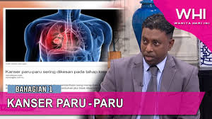 Upload, livestream, and create your own videos, all in hd. Kanser Paru Paru Bhg 1 Whi 18 Jan 2020 Youtube