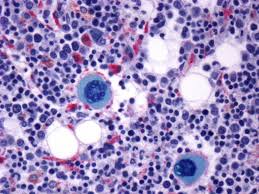The bone is made up of compact bone, spongy bone, and bone marrow. The Link Between Bone Marrow And Cancer