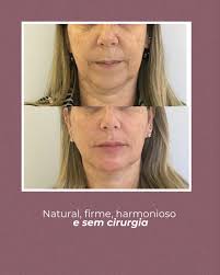 Um lifting natural, com mais sustentação e leveza no olhar — sem bisturi,  sem susto, e do jeitinho que ela queria. Se você também sente que seu rosto  tá pedindo atenção, 📍