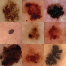Ultraviolet light exposure from the sun or tanning beds is the greatest risk factor for developing skin cancers. Melanoma Flying Skin Cancer Doctor