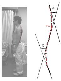 We did not find results for: The Angle Of Maximum Thoracic Kyphosis And Maximum Lumbar Lordosis Download Scientific Diagram