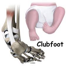 Clubfoot describes a range of congenital foot abnormalities. Clubfoot Eorthopod Com