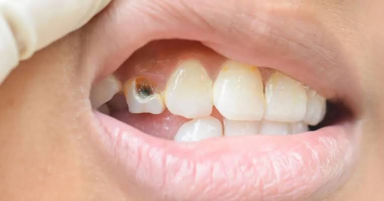 Gumline Cavity: Causes, Early Signs, Treatment and Prevention.