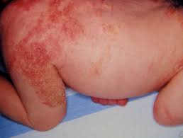 Neonatal herpes is a rare disorder affecting newborn infants infected with the herpes simplex virus (hsv), also called herpesvirus hominis. Blisters And Pustules In Neonates Dermnet Nz