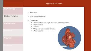 Image result for Cardiovascular Syphilis