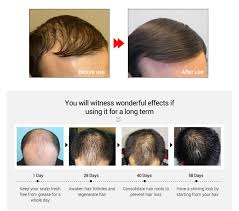 Some say that fatty acids contribute to healthy hair follicles which could also help increase hair growth. Fast Hair Growth Essence Oil Cure Calp Strengthen Wesboutique
