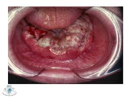 Cancer in the bones of the spine can press on nerves, causing numbness and tingling or even. Oral Cancer By J Shah