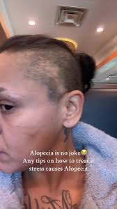 Understanding Stress-Induced Alopecia and Treatment Tips