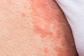 A manchas brancas na pele podem aparecer por diversos fatores, podendo ser devido à exposição prolongada ao sol ou ser consequência de infecção por fungo, por exemplo, que pode ser facilmente tratada com cremes e pomadas que podem ser indicados pelo dermatologista. 7 Tipos De Micose De Pele E Como Tratar Tua Saude