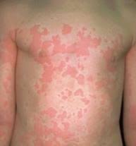 Maybe you would like to learn more about one of these? Obat Gatal Ruam Pada Kulit Perut Orang Dewasa Obat Gatal Ruam