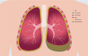 Leukemic thrombi in vessels → infarctions. Pleural Effusion And Ascites Pfm Medical Ag