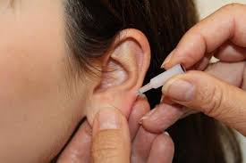 Les points d'acupuncture viennent stimuler la production d'endorphines et bloquer les récepteurs cérébraux responsables de l'envie de fumer. Acupuncture Auriculaire Anti Tabac Praxis Hartgens Heilpraktiker Gmbh