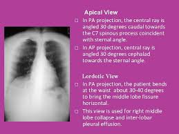 A method for examining a chest. Chest X Ray Anatomy And Projections Evaluating Chest