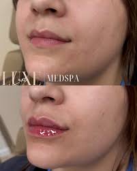 That Cupid's bow? Slayyyy babe 🫶🏼 Subtle, sculpted, and oh-so-kissable  —my lip filler technique enhances your natural shape with precision and  balance. No duck lips. No drama. Just LUXE, lifted lips! 💉✨