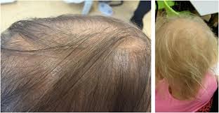 Some with autoimmune diseases, such as alopecia, need the help of wigs for kids help until they reach age 18, while other children with temporary hair loss due to chemotherapy or radiation therapy may only need treatment for a couple of years. Permanent Diffuse Alopecia After Haematopoietic Stem Cell Transplantation In Childhood Bone Marrow Transplantation