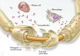 Maramattom et al in annals of neurology. Guillain Barre Syndrome Fact Sheet Nurses Zone Source Of Resources For Nurses