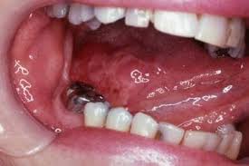 Image result for spinocellular carcinoma of the oral cavity