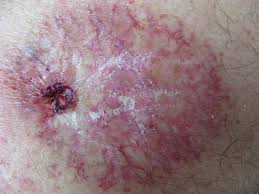 Image result for Radiation Dermatitis