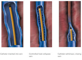 Image result for Radiofrequency Surgery