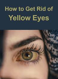 How To Get Rid Of Yellow Eyes Yellow Eyes Yellow Eyes Causes Itchy Eyes