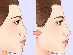 Nak hidung mancung punya pasal. Adakah Suara Saya Akan Bertukar Selepas Hidung Mancung Erufu Care