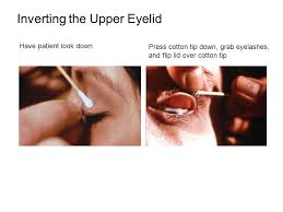 It is due to changes in the tissues where a tissue component called elastin changes or is destroyed, leading to stretchy, floppy skin. The Prevention And Management Of Eye Injuries Ppt Video Online Download