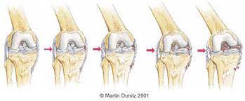 A grade 2 mcl injury means that your ligament has been partially torn. Medial Collateral Ligament Sprain Mcl Sprain In Depth Knee