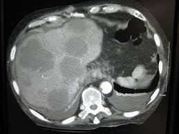 It's also known as stage 4 breast cancer. Department Of Surgery Liver Metastases