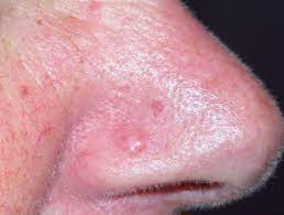 It is curable in its early stages. Fibrous Papule Of The Nose Dermnet Nz